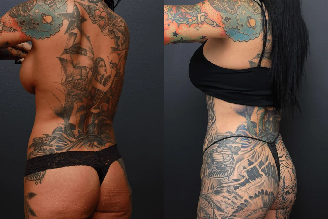 100348-Left Posterior Oblique combined