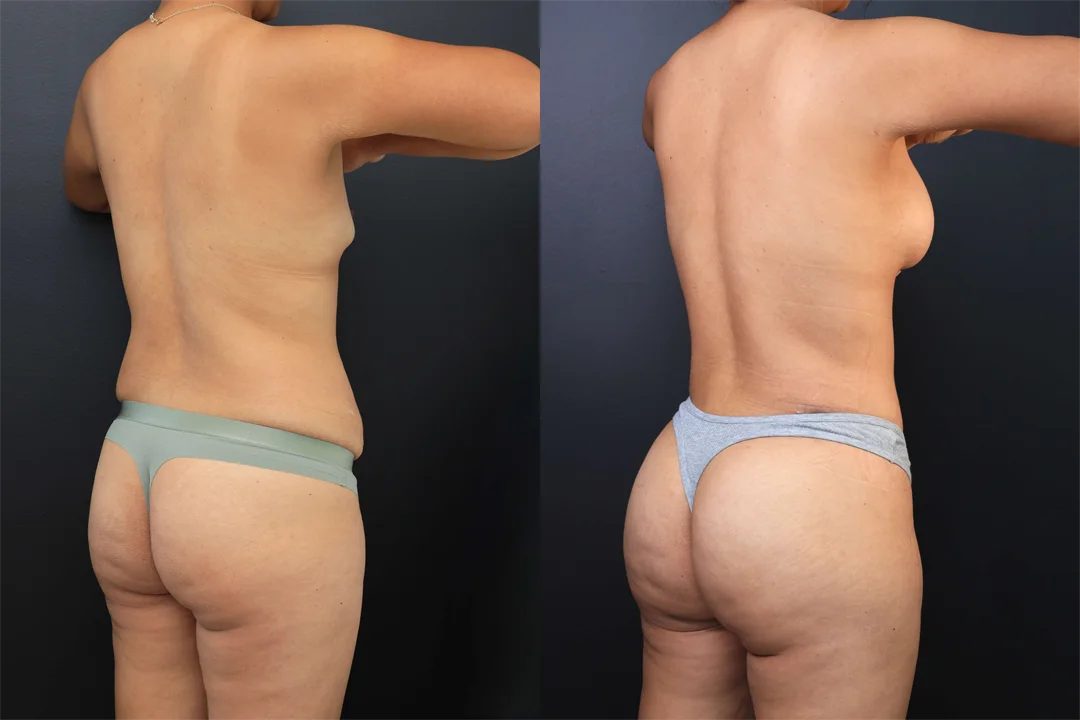102301-Right Posterior Oblique combined