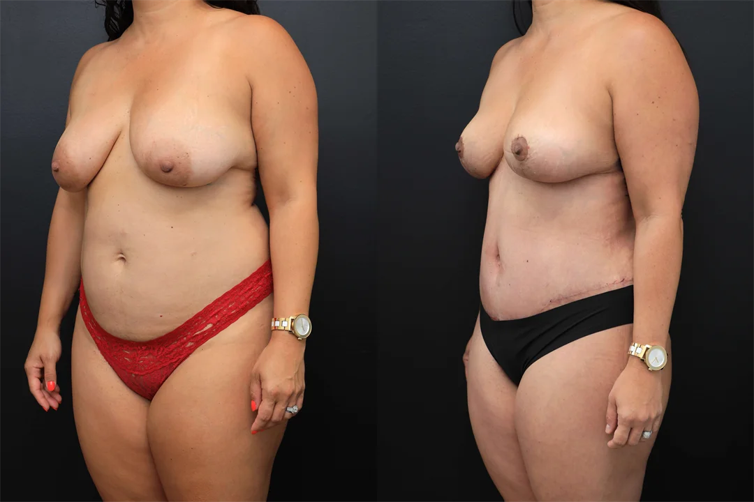 102315-Left Oblique combined