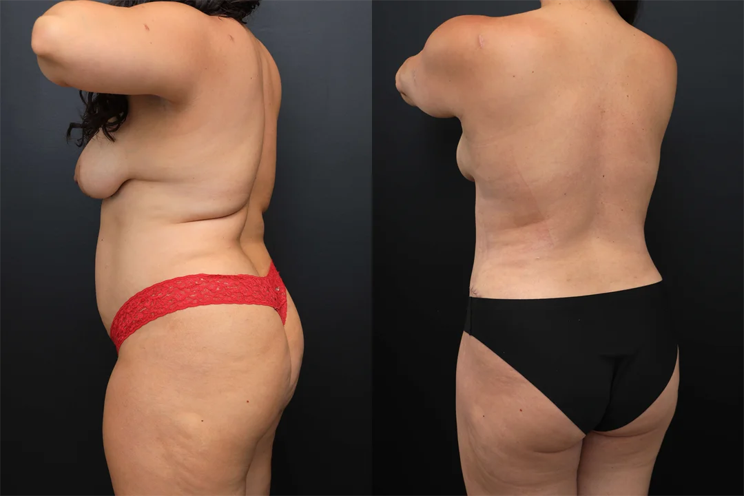 102315-Left Posterior Oblique combined