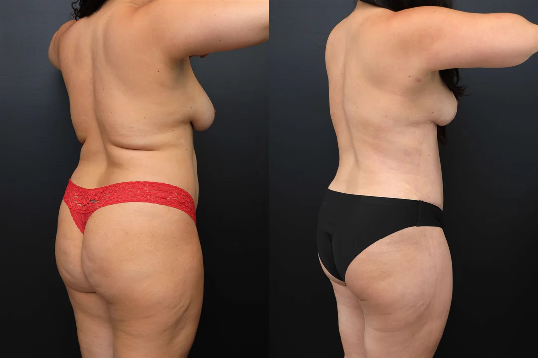 102315-Right Posterior Oblique combined
