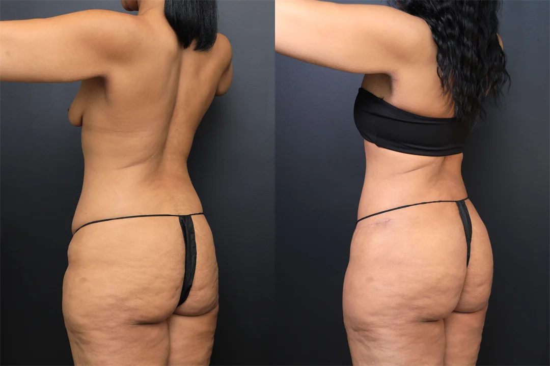 102366-Left Posterior Oblique combined
