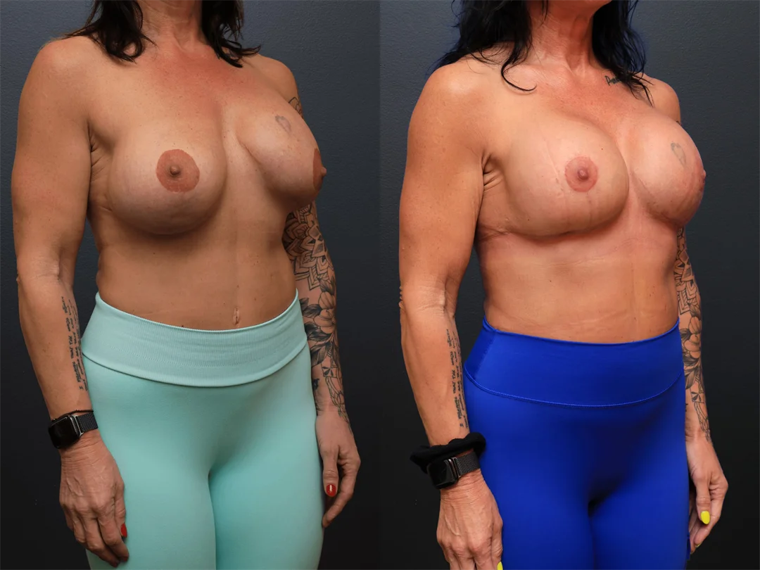 105358-Right Oblique combined