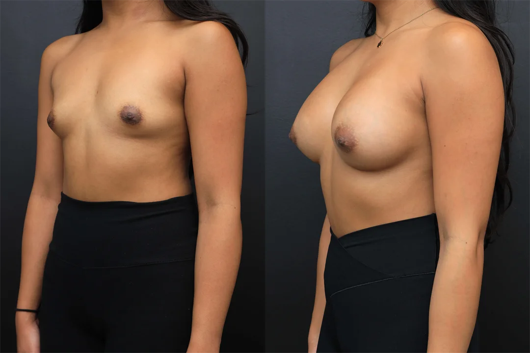 106420-Left Oblique combined