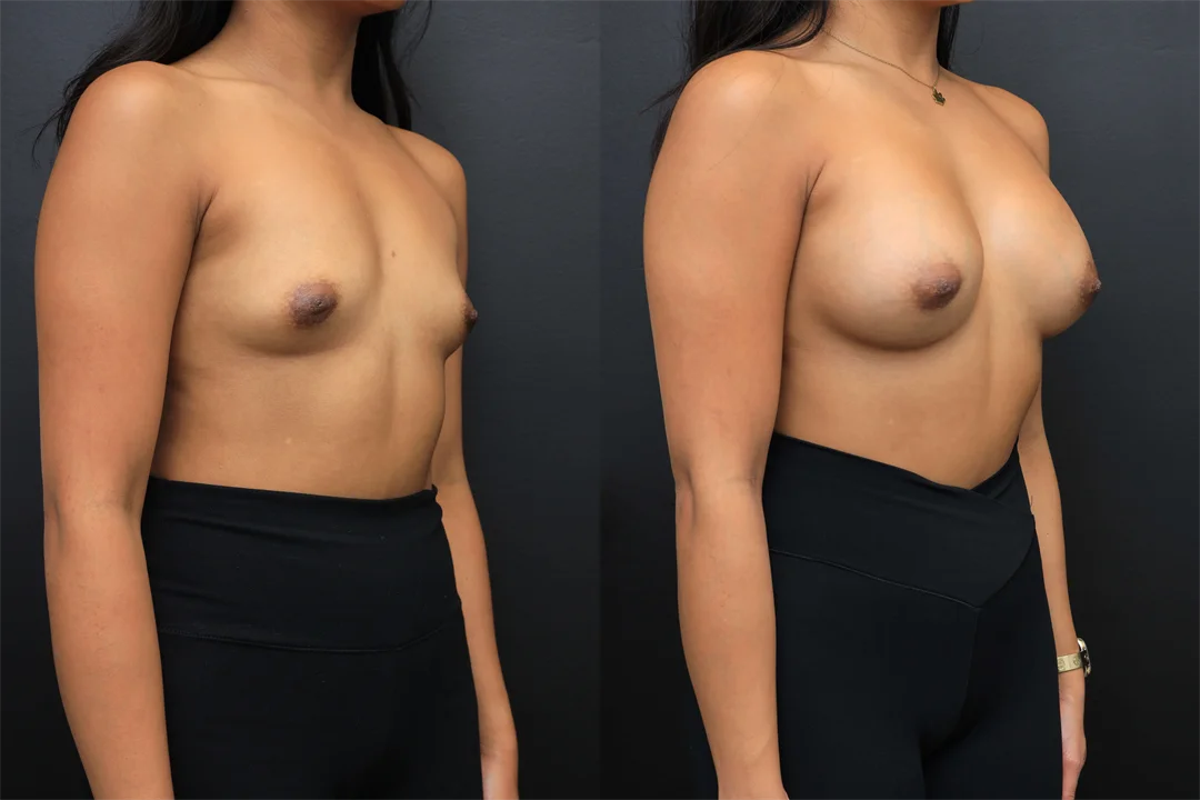 106420-Right Oblique combined