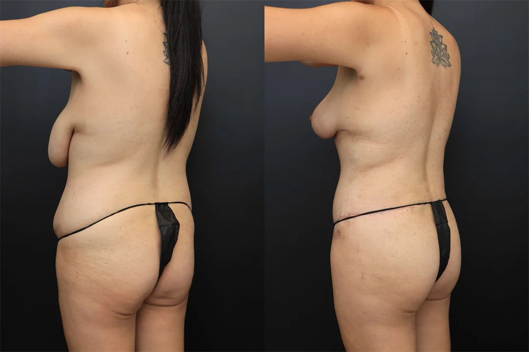 106422-Left Posterior Oblique combined