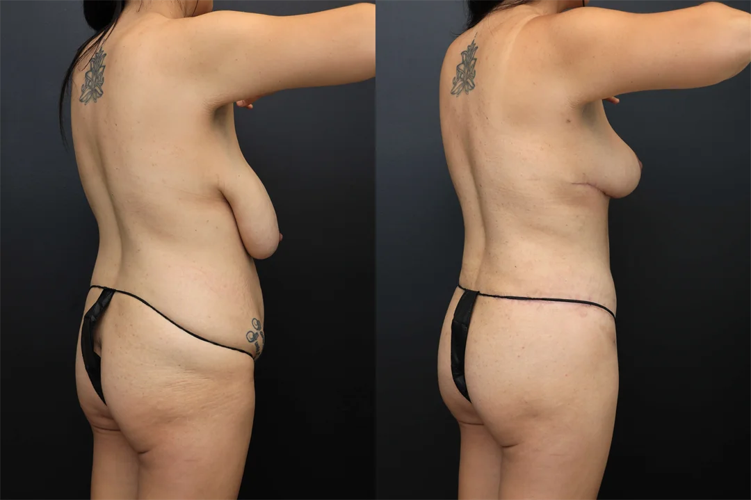 106422-Right Posterior Oblique combined