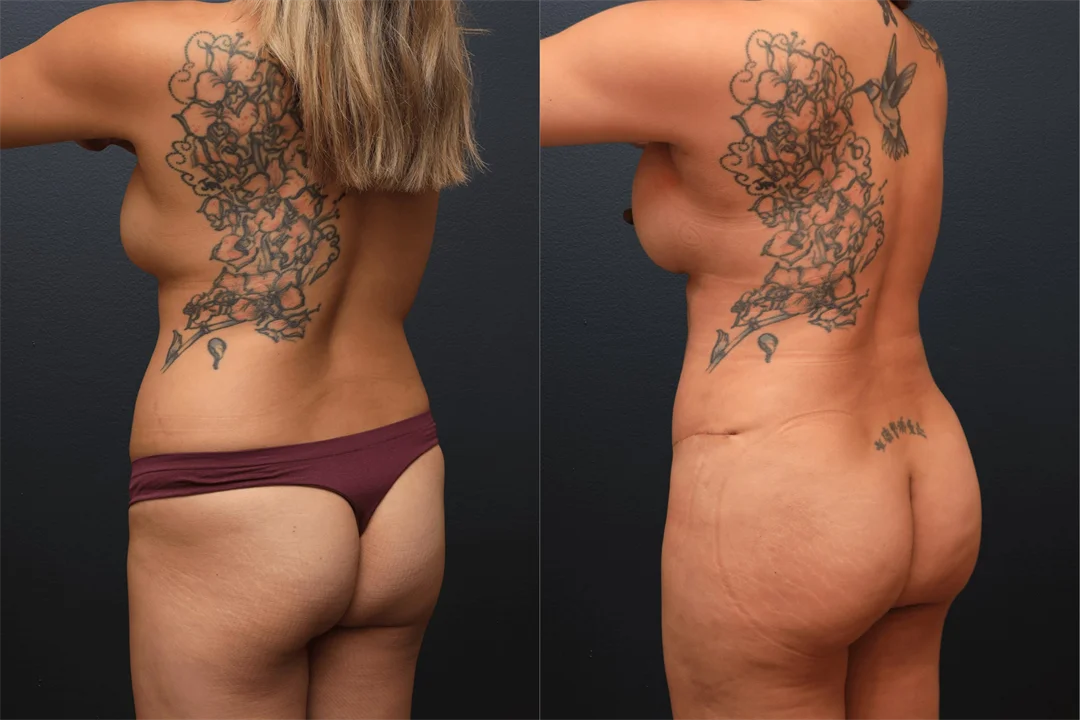106688-Left Posterior Oblique combined