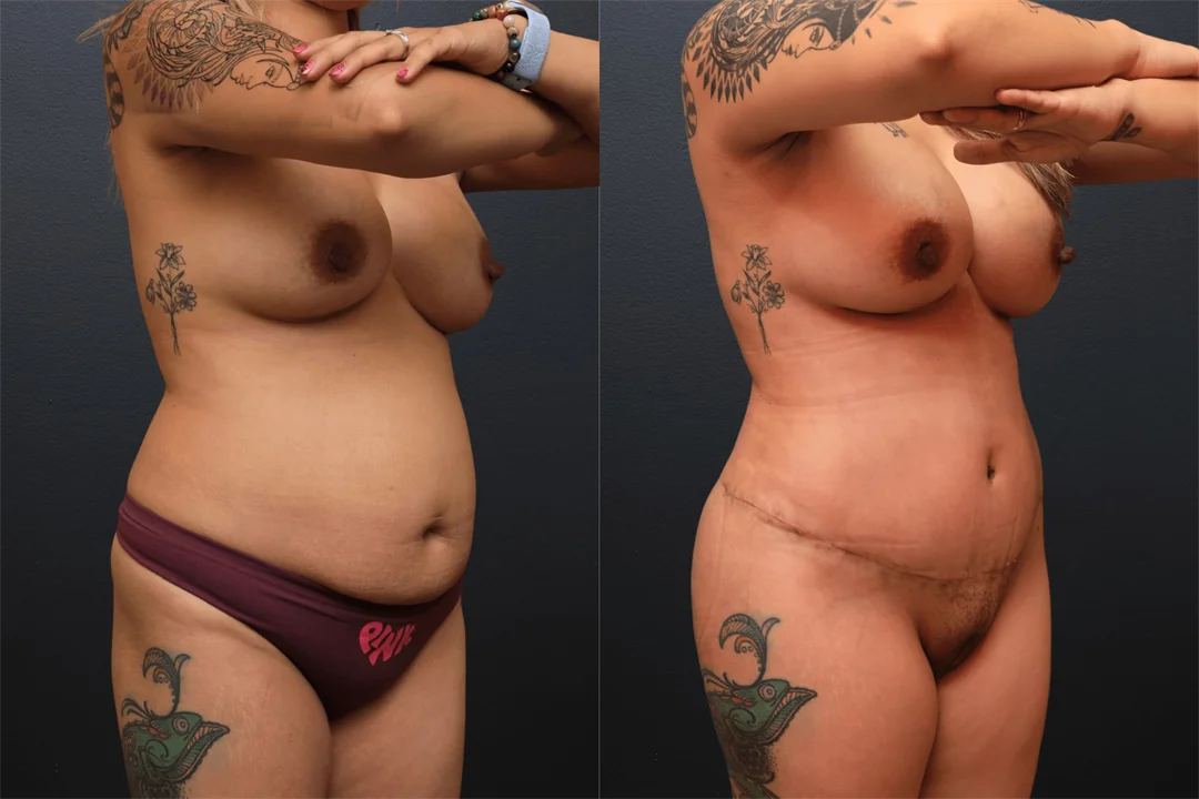 106688-Right Oblique combined