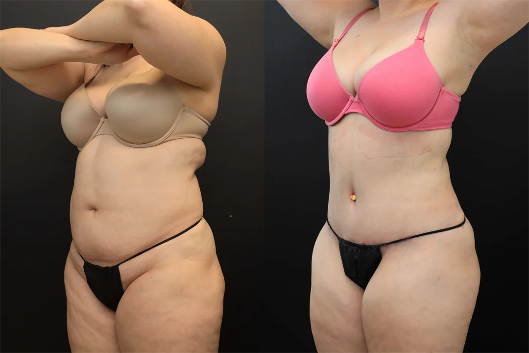 106692-Left Oblique combined