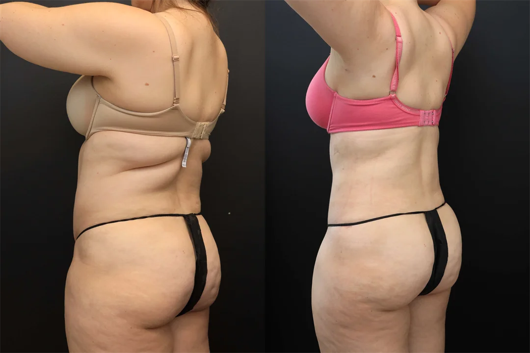 106692-Left Posterior Oblique combined