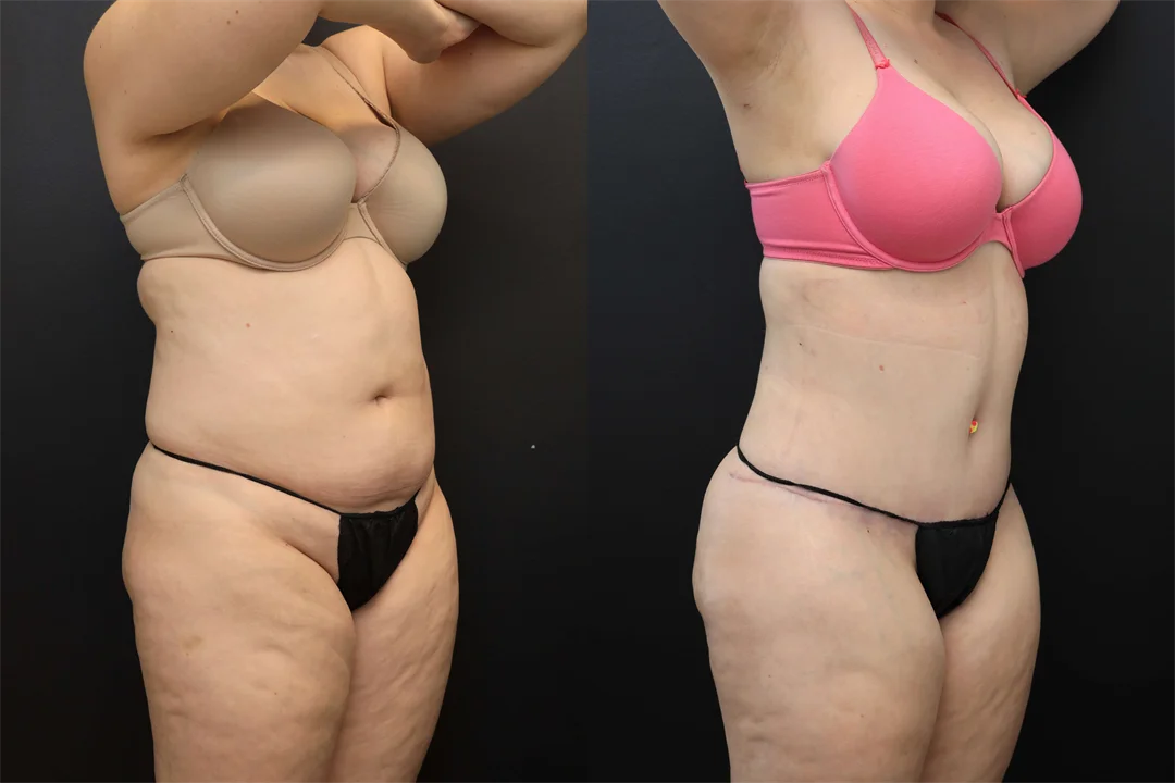 106692-Right Oblique combined