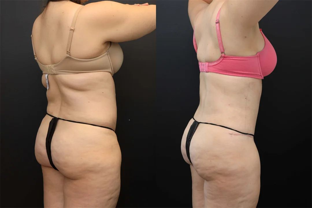 106692-Right Posterior Oblique combined