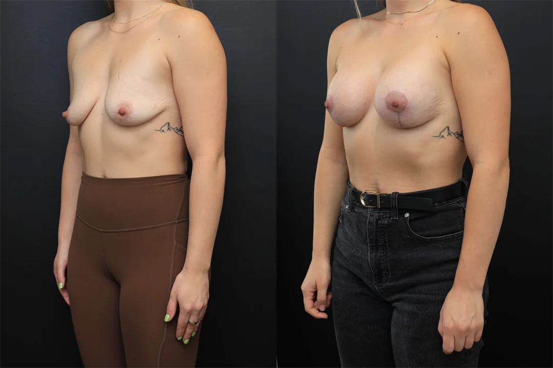 106693-Left Oblique combined