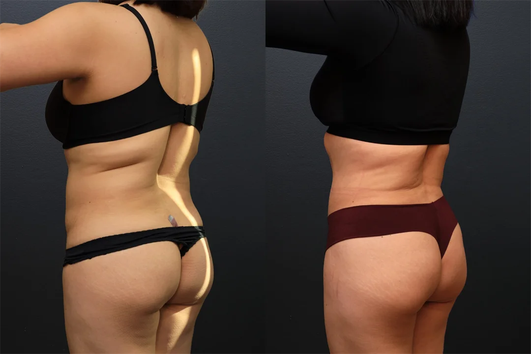 106694-Left Posterior Oblique combined