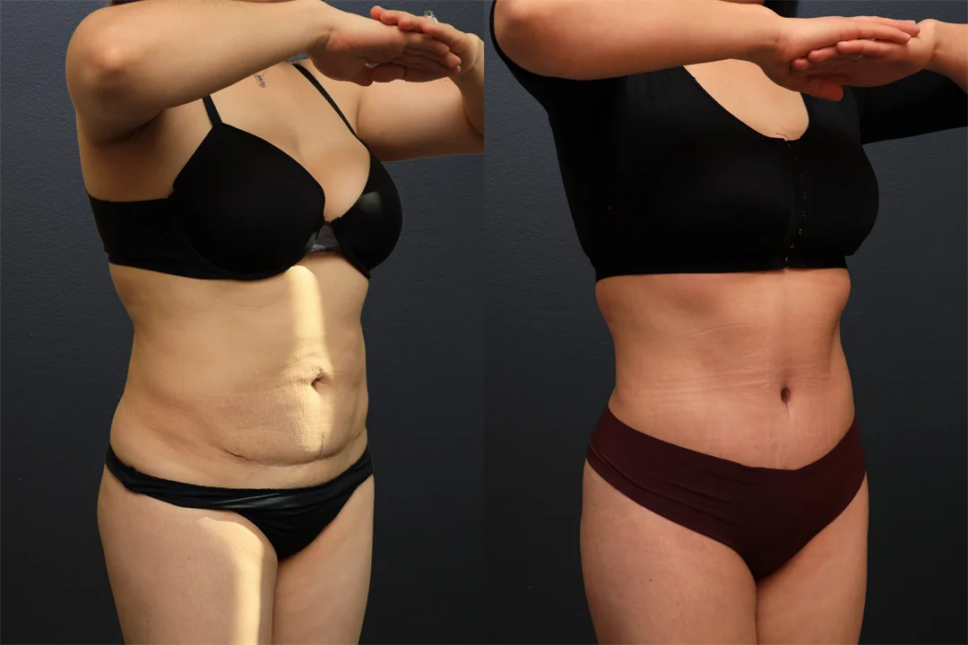 106694-Right Oblique combined