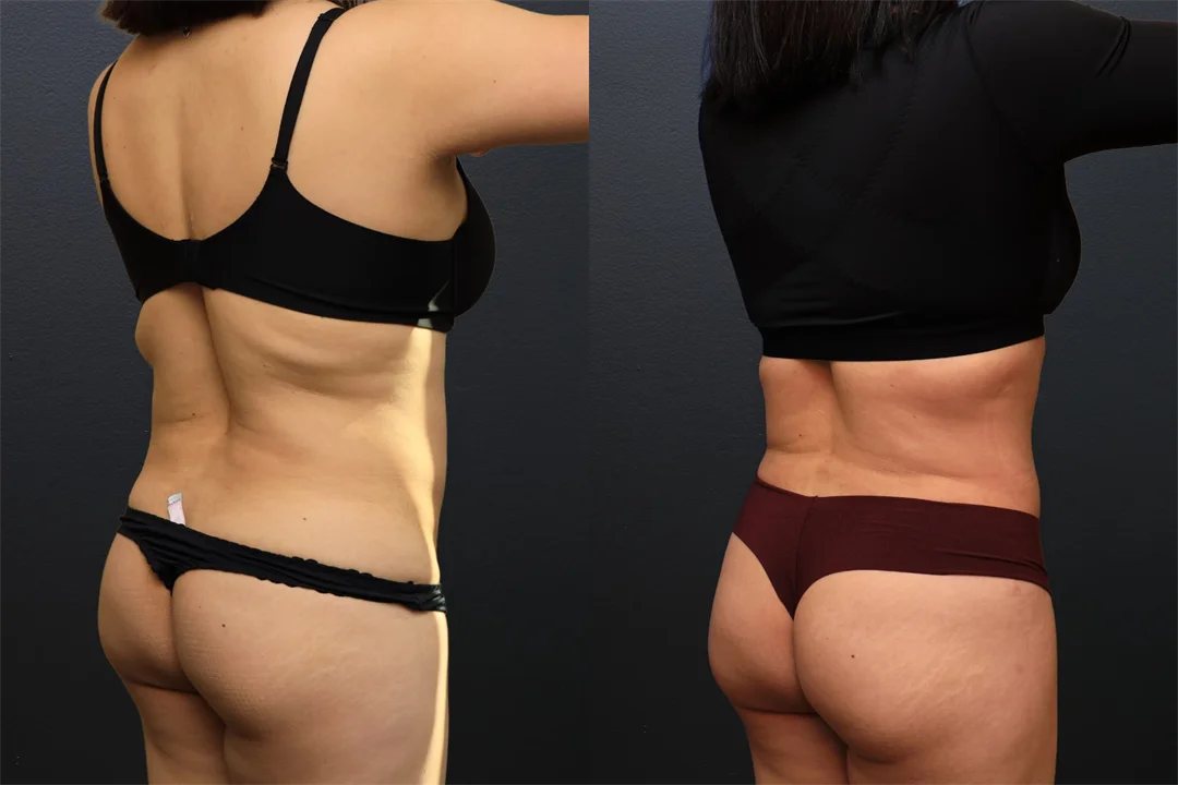 106694-Right Posterior Oblique combined