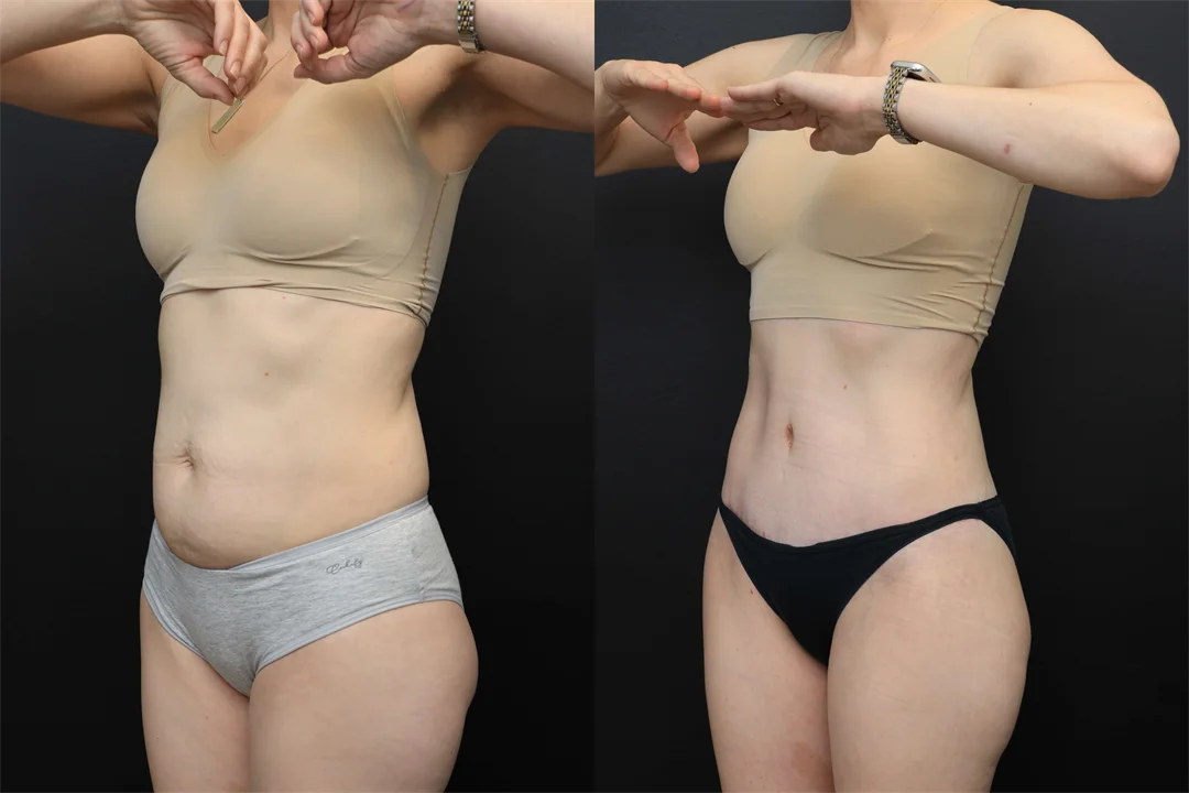 106863-Left Oblique combined
