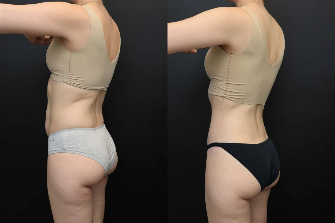 106863-Left Posterior Oblique combined