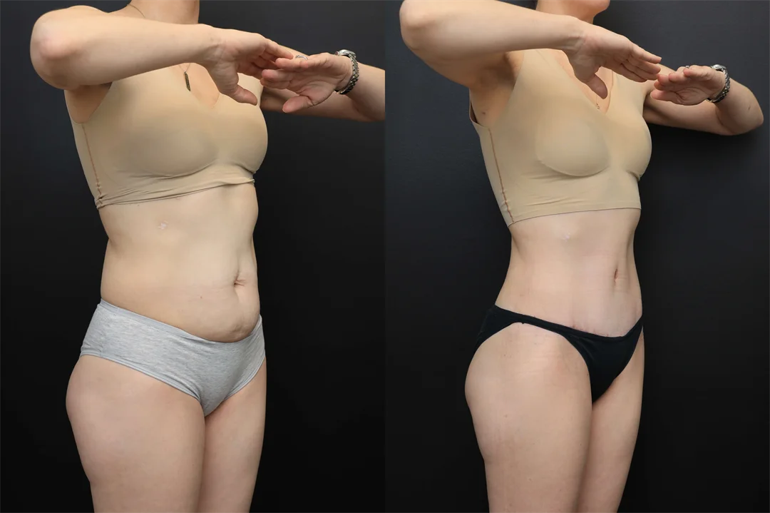 106863-Right Oblique combined