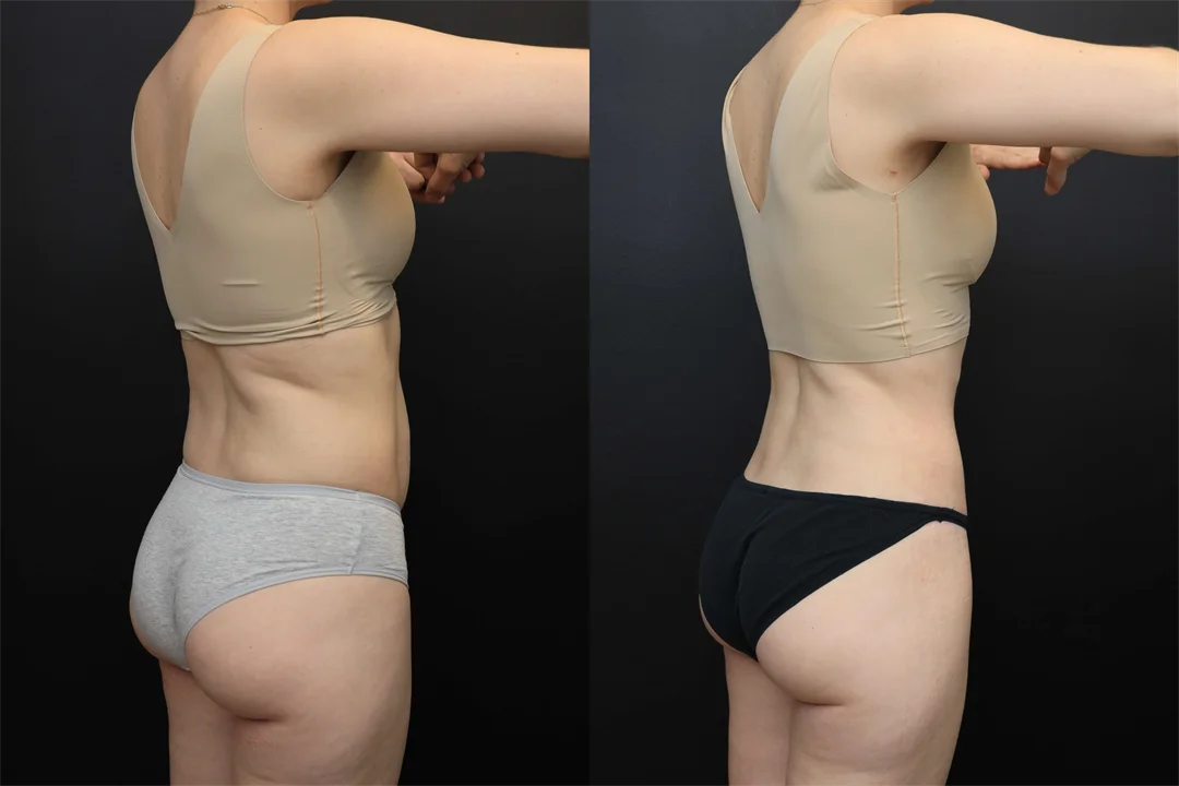 106863-Right Posterior Oblique combined