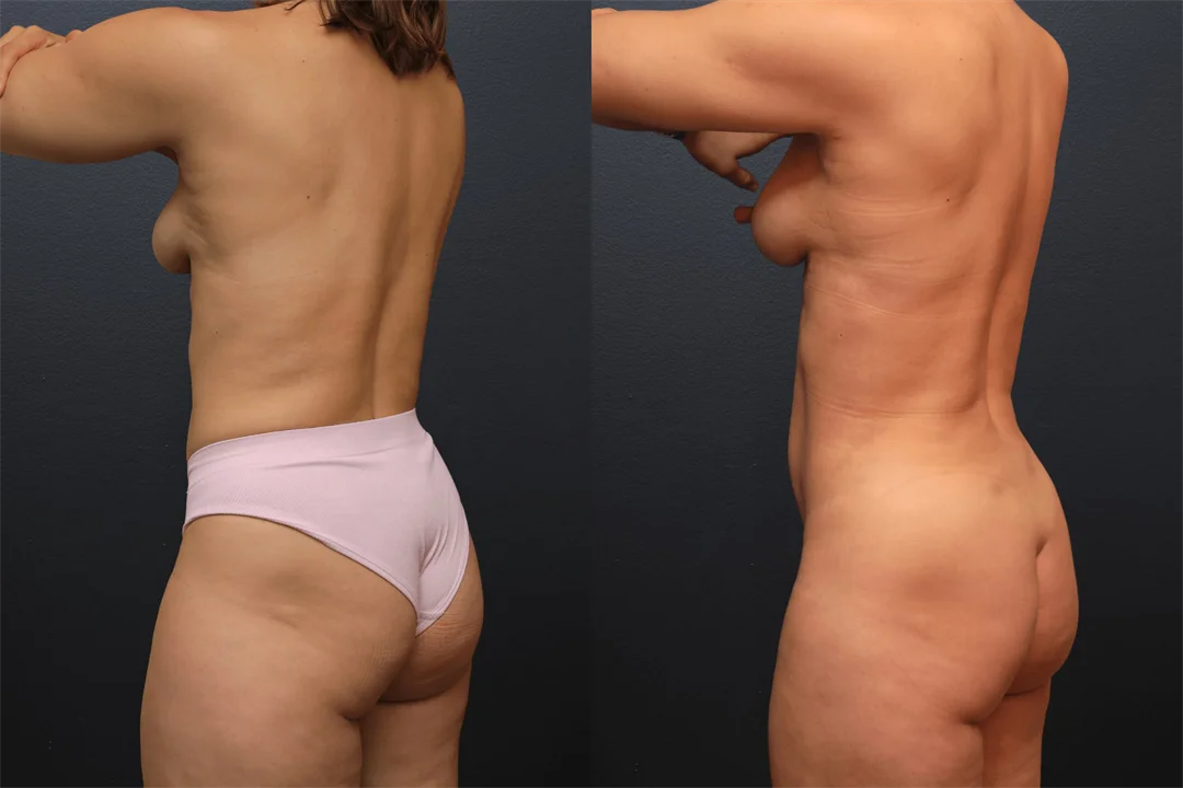 107848-Left Posterior Oblique combined