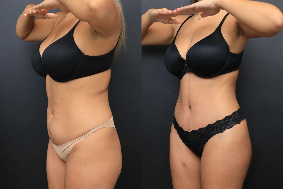 107849-Left Oblique combined