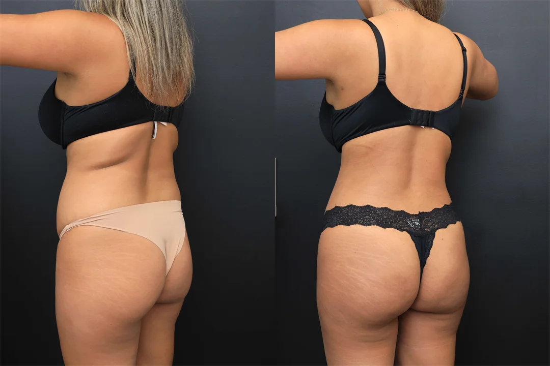 107849-Left Posterior Oblique combined