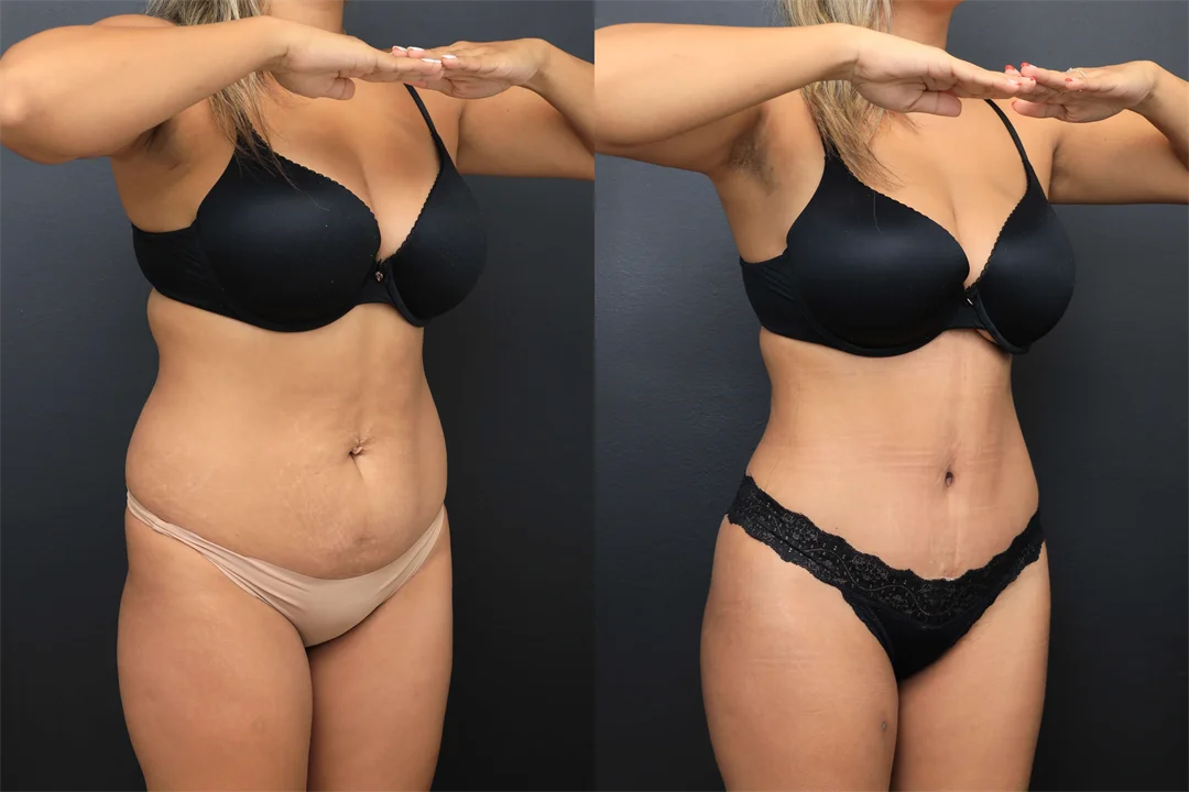 107849-Right Oblique combined