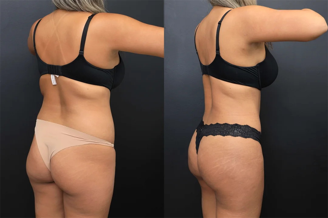 107849-Right Posterior Oblique combined