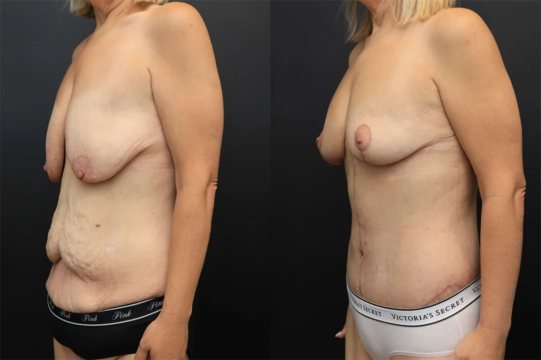 107946-Left Oblique combined