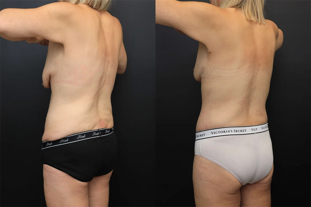 107946-Left Posterior Oblique combined