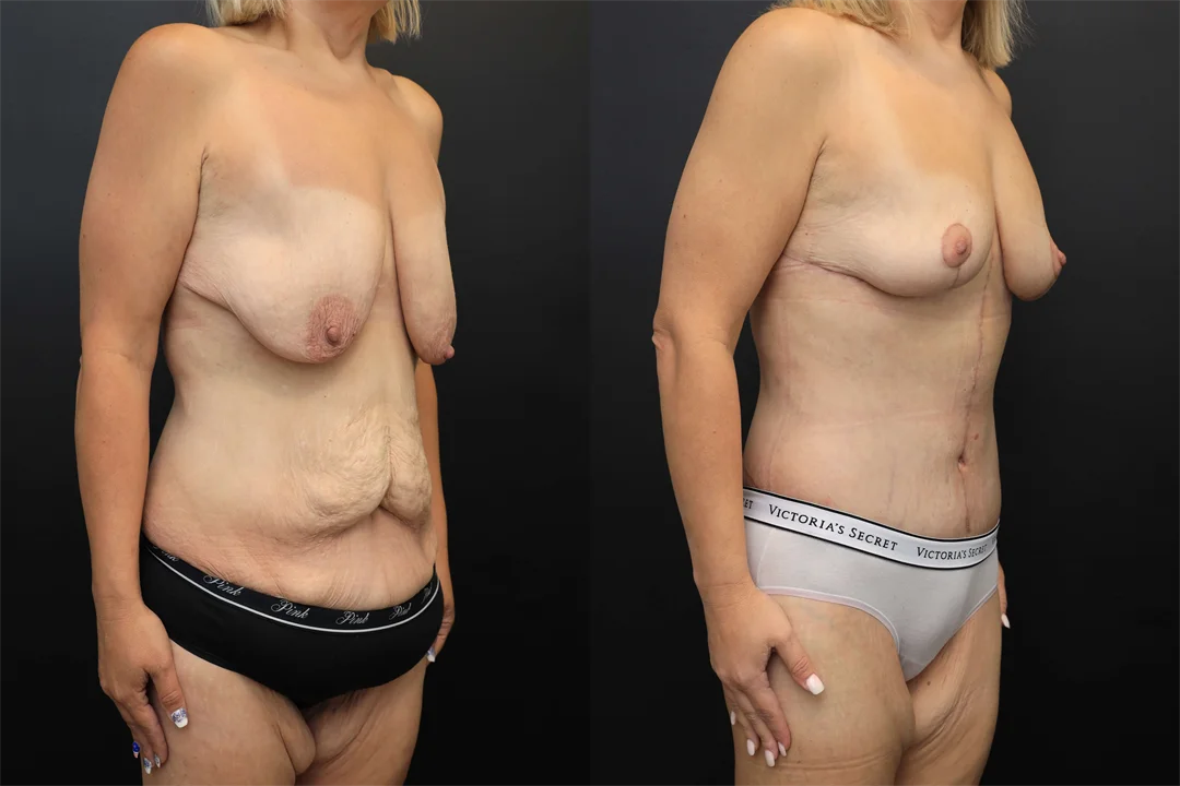 107946-Right Oblique combined