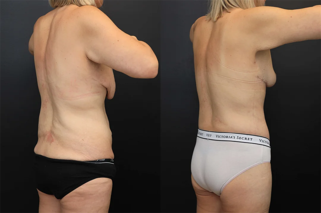 107946-Right Posterior Oblique combined