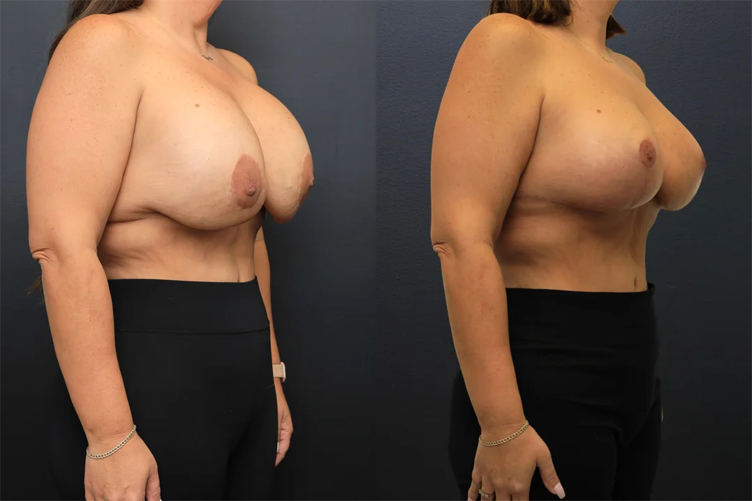 108666-Right Oblique combined