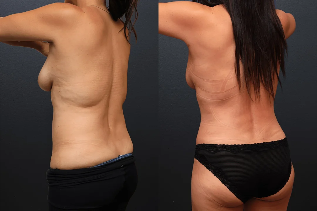 108667-Left Posterior Oblique combined