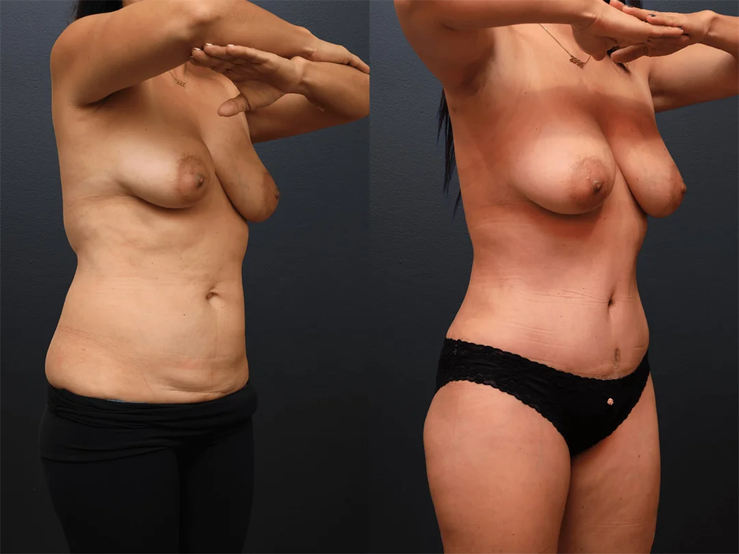 108667-Right Oblique combined