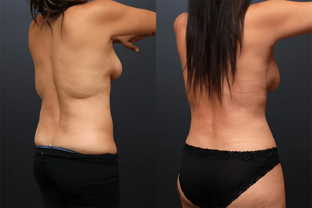 108667-Right Posterior Oblique combined