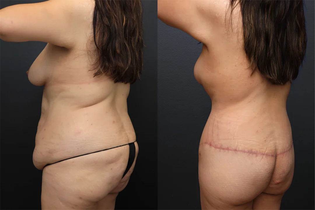108764-Left Posterior Oblique combined