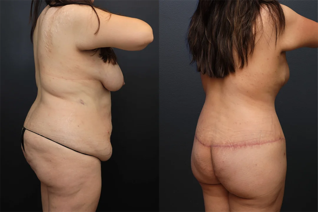 108764-Right Posterior Oblique combined