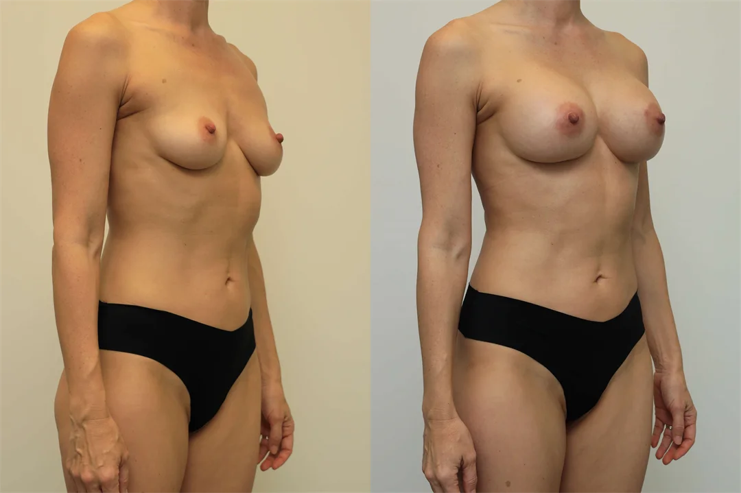 109294-Right Oblique combined