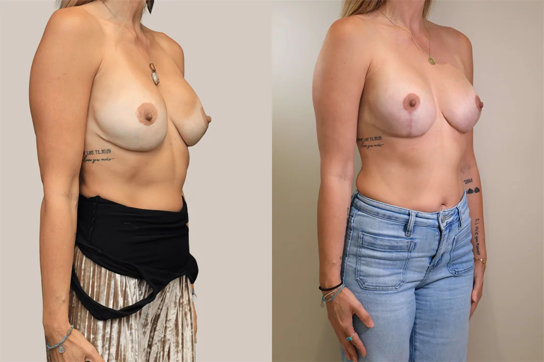 109295-Right Oblique combined