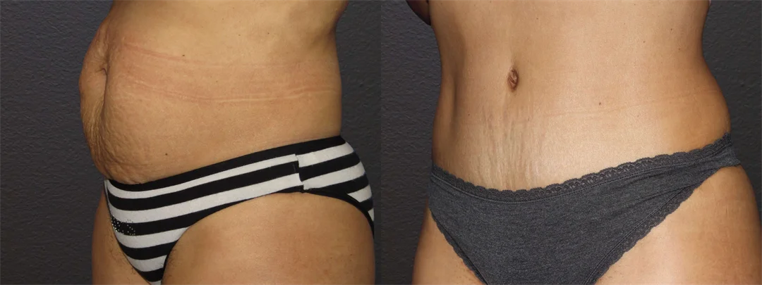 66813-LEFT OBLIQUE Before