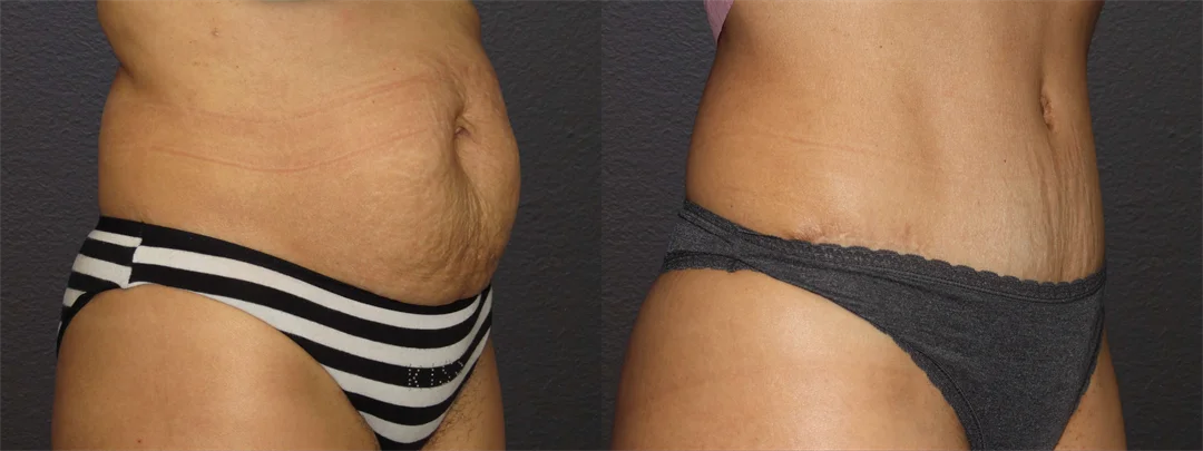 66813-RIGHT OBLIQUE Before