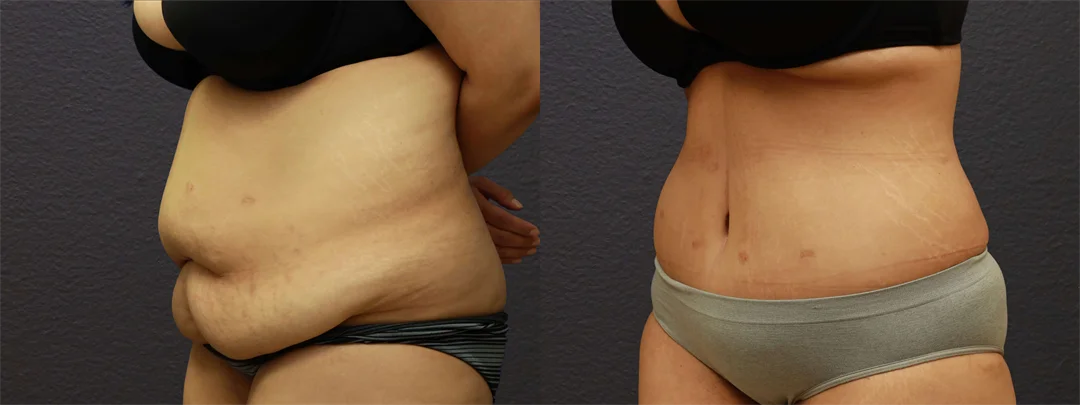 66815-LEFT OBLIQUE Before