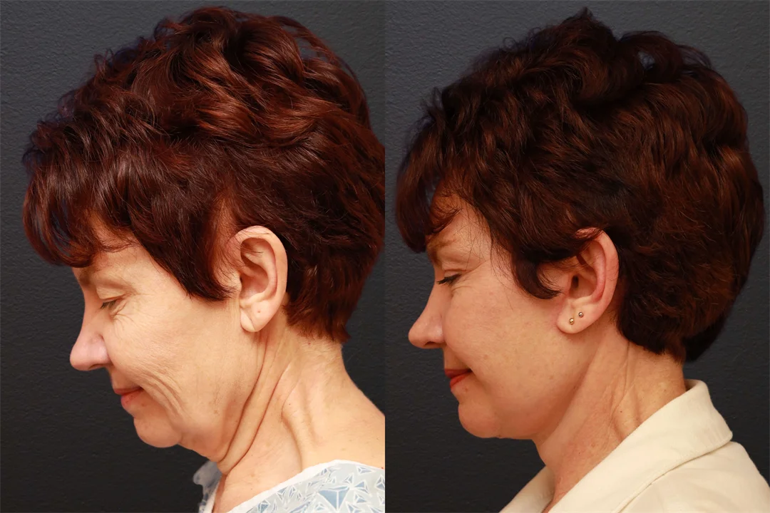 66848-LEFT LATERAL FLEXED combined