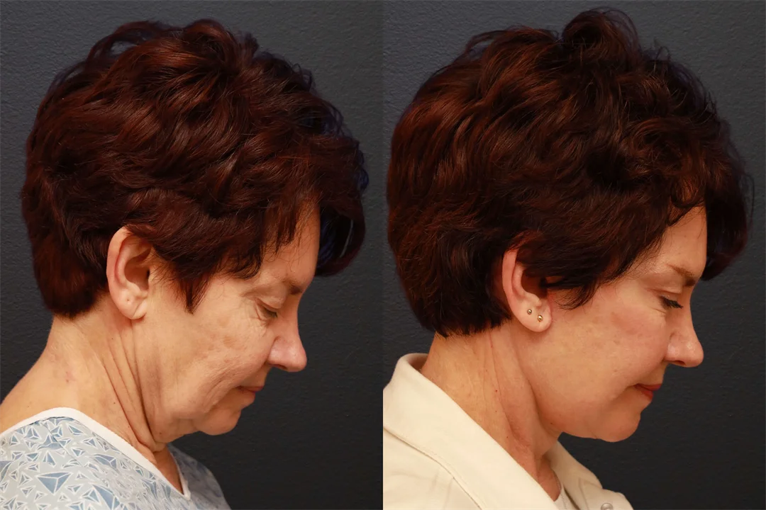 66848-RIGHT LATERAL FLEXED combined