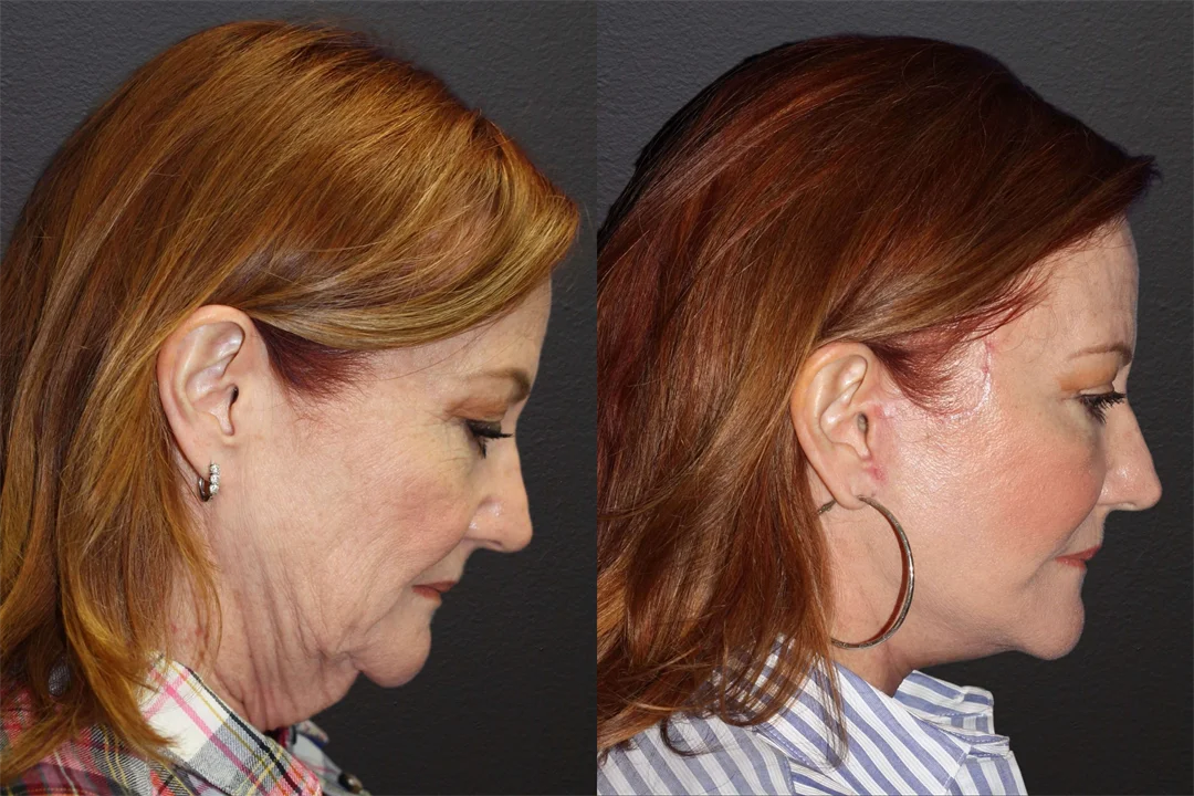 66897-RIGHT LATERAL FLEXED combined