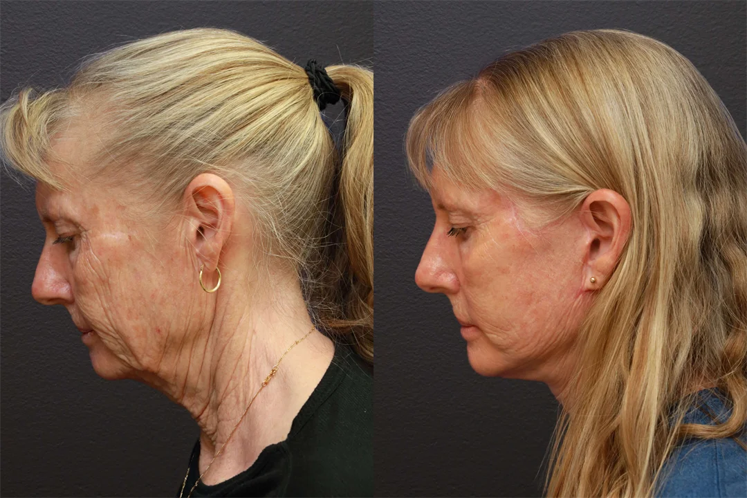 66898-LEFT LATERAL FLEXED combined