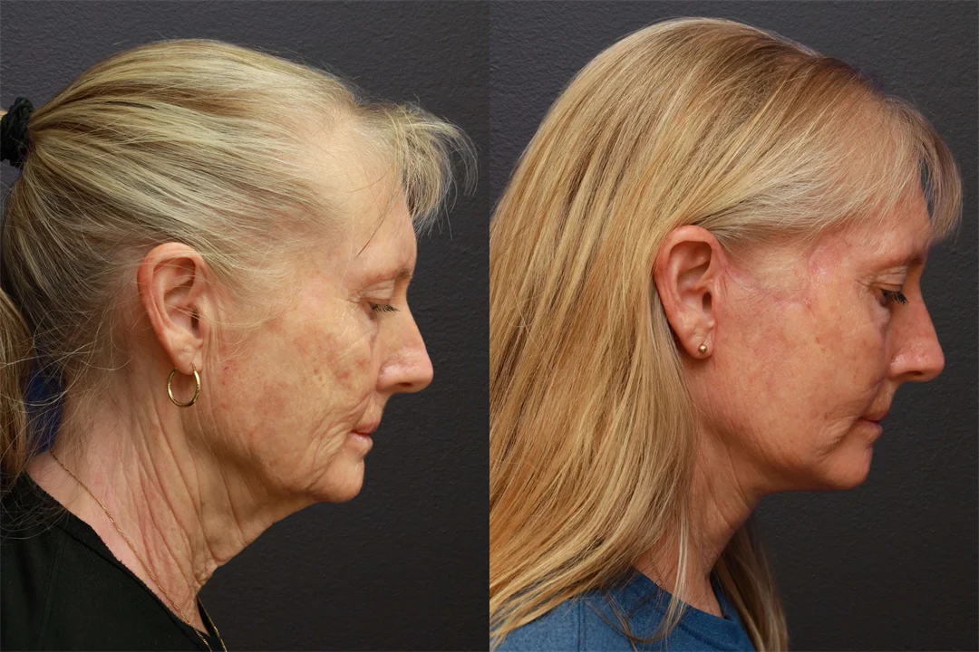 66898-RIGHT LATERAL FLEXED combined